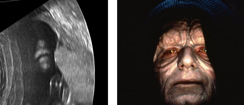 http://www.dailymail.co.uk/news/article-2291546/May-face-Parents-shock-babys-ultrasound-looks-like-evil-Star-Wars-emperor-Palpatine.html
